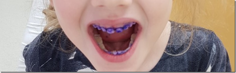 Zahnbelag anfaerben Zahnarzt